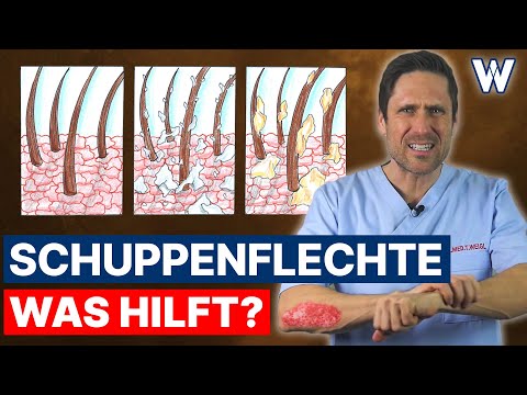 Schuppenflechte: Rote Haut, starker Juckreiz und Schuppenbildung! Ist Psoriasis heilbar? Was hilft?