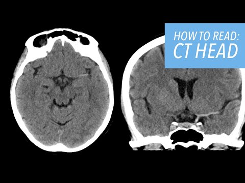 How to Read a CT Head: A Beginner's Approach