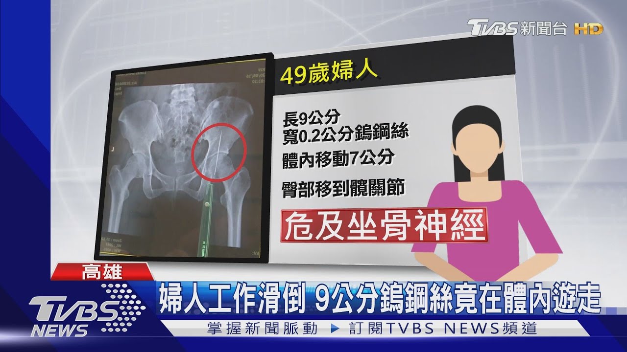 婦人工作滑倒 9公分鎢鋼絲竟在體內遊走