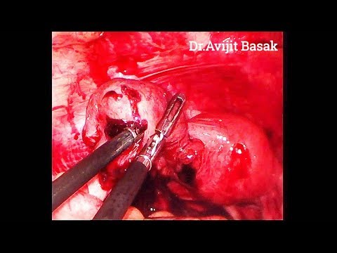 Extrauteringravidität (EUG)- laparoskopische Chirurgie (Dr.Avijit Basak)
