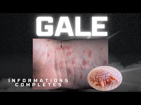 La gale expliquée | Symptômes, causes, traitement et prévention