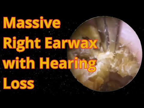Massive Right Earwax with Hearing Loss - Earwax Removal Compilation