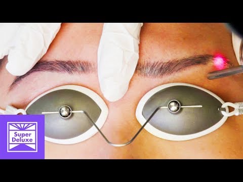Laser Tattoo Removal | Nice Content | Tatered