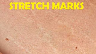 how to get rid of stretch marks on stomach male