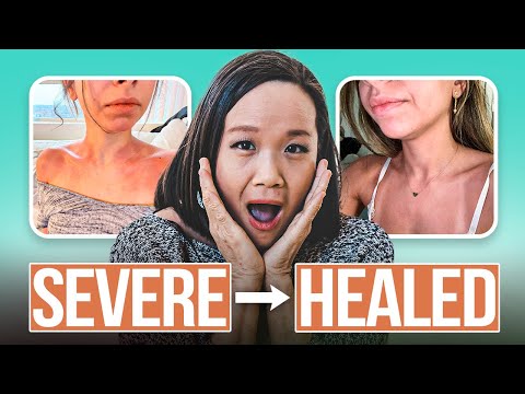 How Hadeel Healed Her Severe Eczema: A Real-Life Recovery Story