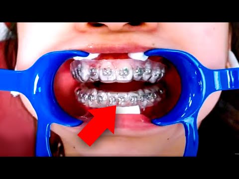 The FASTEST way to put on braces...McKinney Orthodontist REACTS