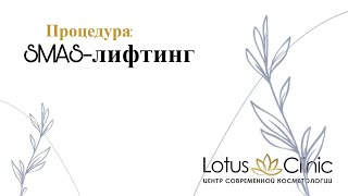 SMAS-лифтинг лица