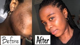 HOW I CURED EXCEMA (Atopic Dermatitis)  on black skin || burning sensation of face, rashes