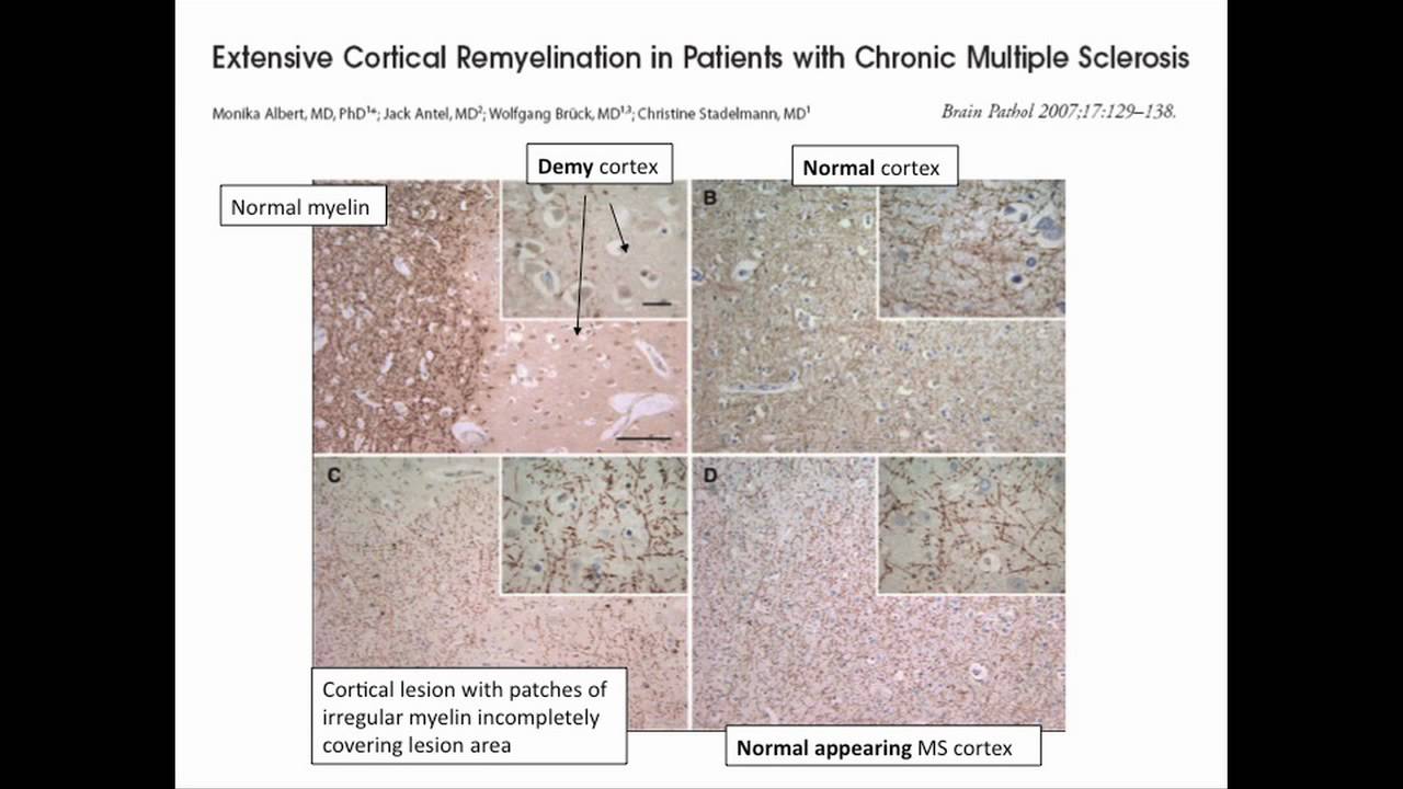 Remyelination - YouTube
