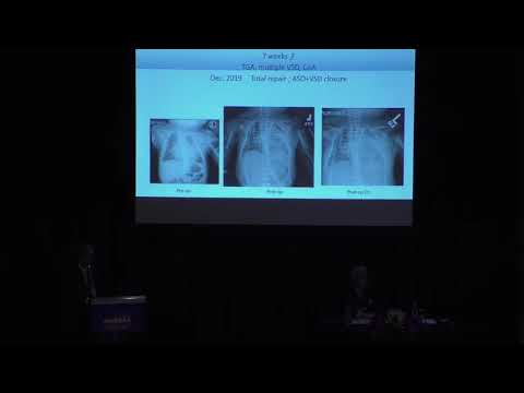 ASCVTS 2020 AATS PG CHD Emergency Surgeries Congenital Heart Surgery