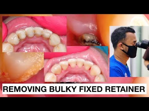 Removing Bulky Fixed Retainer