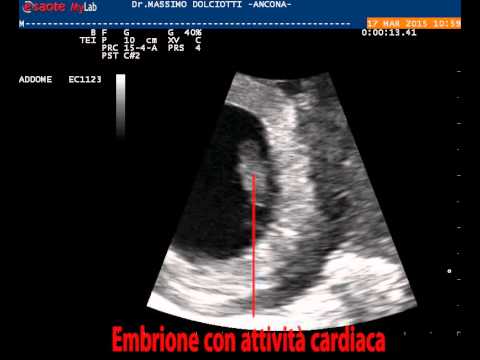 Rinvenimento con osteocondrosi cervicale ICD distorsione dellarticolazione del ginocchio
