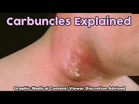 Carbuncles!  Extra Large (Extended) Edition