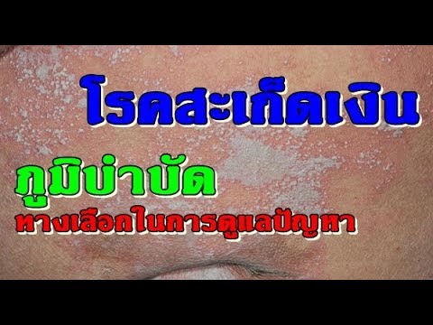 กลากบนหัว โรคสะเก็ดเงินน้ำมันซีดาร์