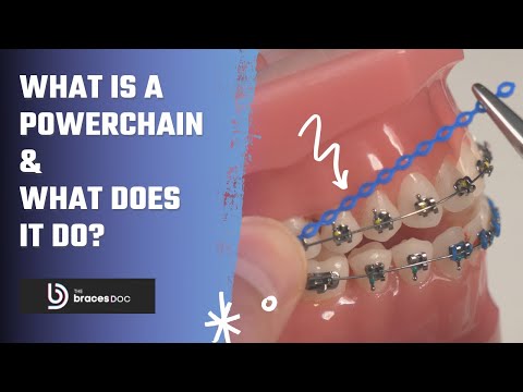 Chain Rubber Band Braces