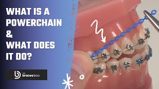 What is a Powerchain | How do Powerchains Work with Braces | How do braces work TheBracesDoc l