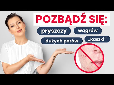 PIMPLES, BLACKHEADS, SHINE - causes and effective methods to get rid of them!