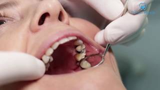 Retirada de los empastes de amalgamas - Dental Pareja Clinic