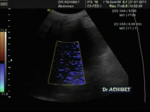 comment guerir de l'ascite