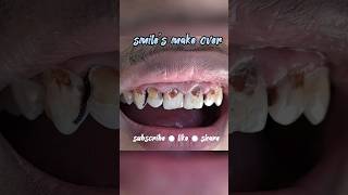 Download lagu TAMBAL DAN VENEER GIGI DEPAN YANG BERLUBANG | SMILE'S MAKE OVER mp3