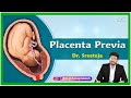 Placenta Previa: Etiology, Pathophysiology, Clinical presentation, Diagnosis and Treatment