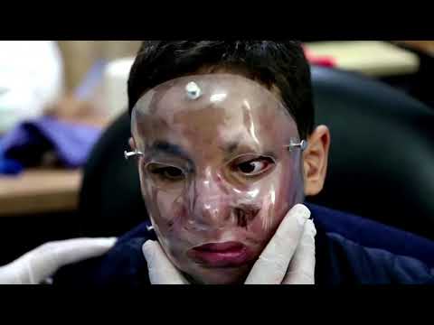 ガザの火傷被害者が3Dプリンターで自宅近くで作ったマスクを手に入れる (Gaza burn victims get 3D-printer face masks made close to home)