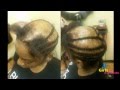 Alopecia Sew-in done by 3 Girls and a Needle ...