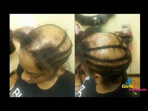 Alopecia Sew-in done by 3 Girls and a Needle