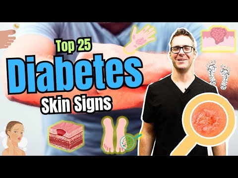 Top 25 Skin Signs & Symptoms of Diabetes [Type 2 Diabetes Early Signs]