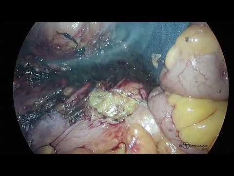 Endometrial Cancer: Laparoscopic paraaortal lymphodenectomy in high BMI Patient