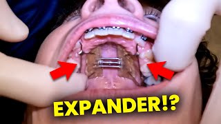 Getting Expander & Braces for Crowing…full walkthrough | McKinney Orthodontist