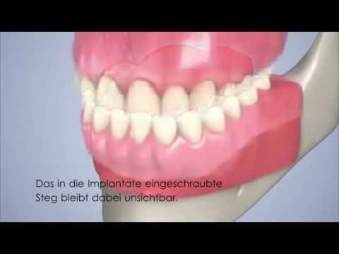 Zahnimplantate Ungarn - Stegprothese