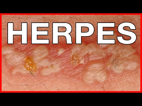 Home remedies for Genital herpes infection Video