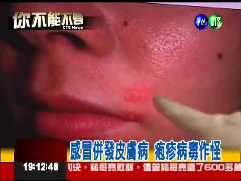 流感肆虐 引發疱疹病毒作怪