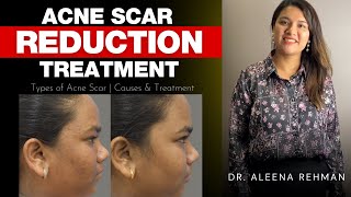 What are the different types of acne scars, and how do I treat them?