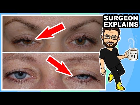 What is the cause of a LAZY EYE? Plastic Surgeon Answers