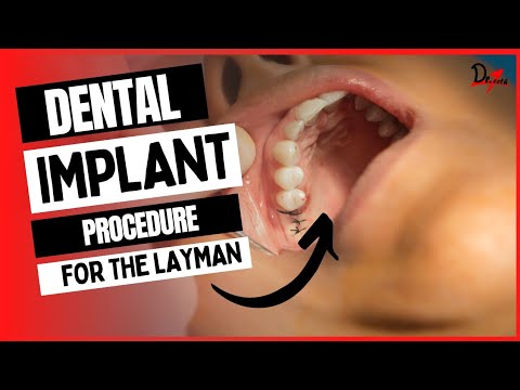 Dental Implant Procedure for the Layman!