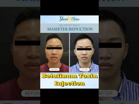 Smooth Forehead Wrinkles & Frown Lines | Original Botox® Treatment