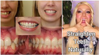 How To Straighten Teeth Naturally, Exercises for Crooked, Overjet, Overbite, Buck Teeth, No Braces