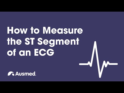 How to Measure the ST Segment of an ECG | Ausmed Explains...