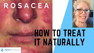 ROSACEA RELIEF: How To Treat Persistent Rosacea & Redness Naturally