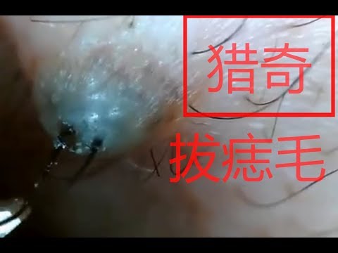 拔痣毛