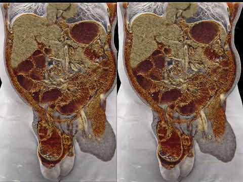 CT Evaluation of Small Bowel Obstruction: Pearls and Pitfalls in Clinical Practice - Part 3