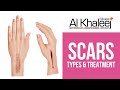 SCARS, TYPES AND TREATMENT | ALKHALEEJ AESTHETIC SURGERY