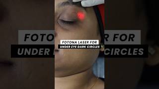 Download lagu Fotona Laser for Under eye Dark Circles | ClearSkin Pune mp3
