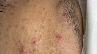 Relaxing Acne Cleansing with LinhMyDang P2 #588