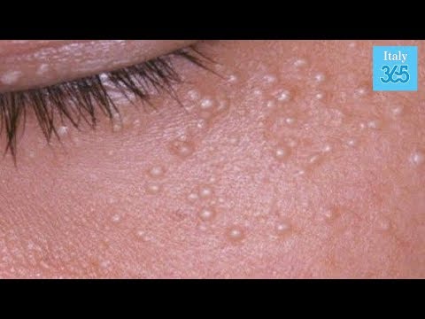 Come espellere un parassita da un occhio Che aglio a vermi è utile