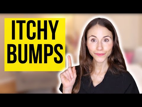 Itchy Bumps On The Skin | Prurigo Nodularis Explained