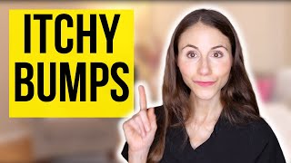 Itchy Bumps On The Skin | Prurigo Nodularis Explained