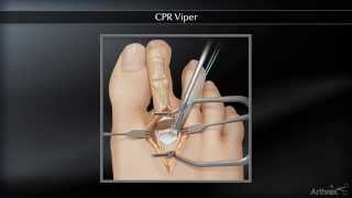 CPR Viper ™